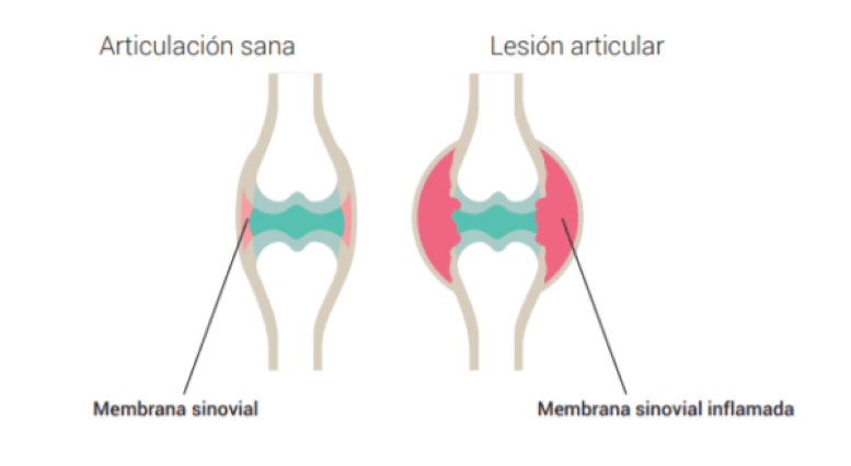 Artritis reumatoide: qué es, síntomas, diagnóstico y tratamiento